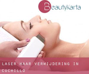 Laser haar verwijdering in Cuchillo