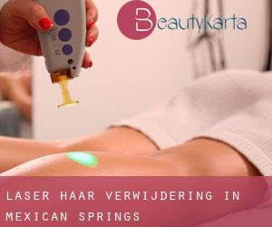 Laser haar verwijdering in Mexican Springs