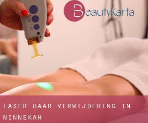 Laser haar verwijdering in Ninnekah